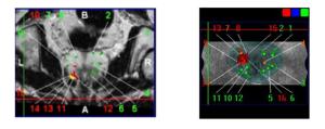 Biopsie de prostate ciblee et guidee par image - fusion echographie et IRM