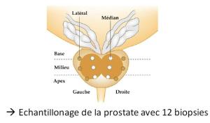 Biopsies de prostate - echantillonage 12 prelevements