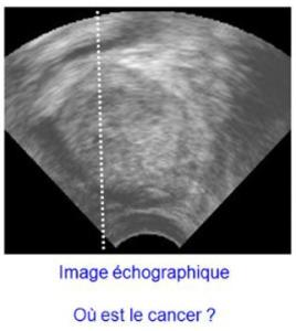 Biopsie - echographie de prostate - ou est le cancer