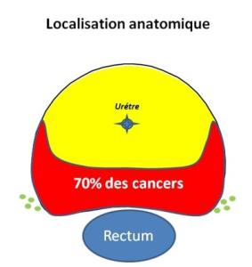 Illustration de la localisation posterieure de 70 pour cents des cancers au sein de la prostate