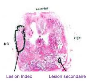 Illustration lésion Index et lésion secondaire du cancer de la prostate - traitements focaux