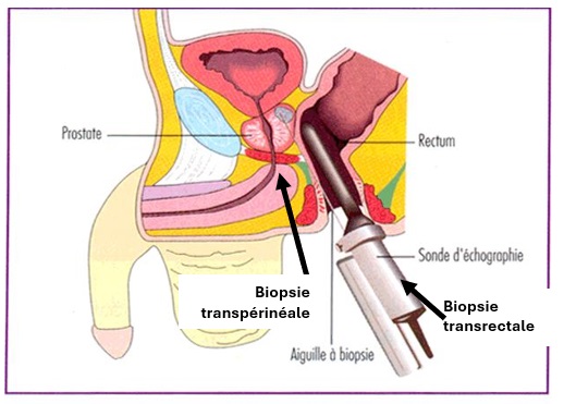 Illustration biopsie de prostate transrectale et transperineale