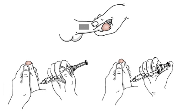 Illustration des injections intracaverneuses après traitement d'un cancer de la prostate