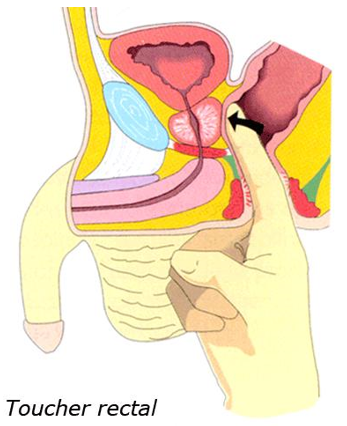Illustration du toucher rectal du cancer de la prostate