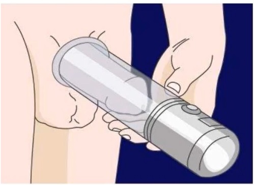 Illustration du vacuum après traitement d'un cancer de prostate - Dr BELEY - Webinaire ANAMACaP