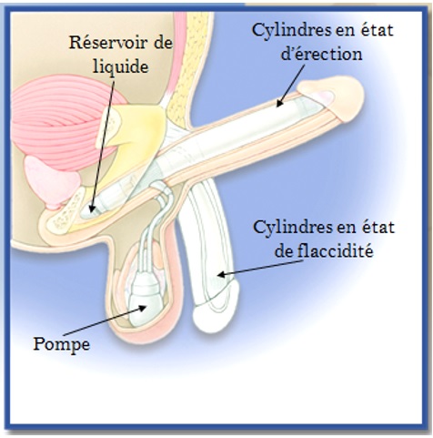 Cancer de la prostate et dysfonction érectile - Illustration d'un implant pénien