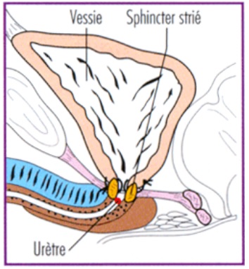 Illustration - suture de la vessie a l'uretre en rouge apres prostatectomie radicale pour un cancer de la prostate