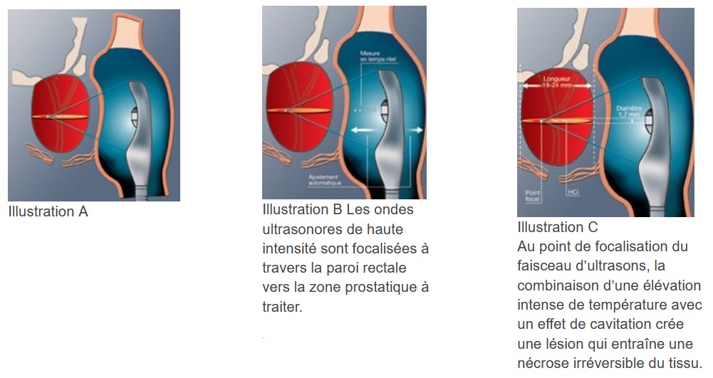 Cancer de prostate et ulstrasons focalisés - illustrations sonde endorectale et faisceau